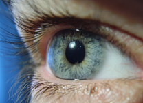 IOL - Blog - Tratamento para diabetes e glaucoma- Fotocoagulação a laser