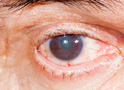 Instituto de Olhos Limongi - Blog - Catarata pode cegar