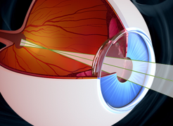 instituto-de-olhos_blog-cirurgia-de-retina-em-vitreo