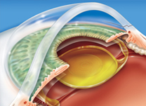 IOL - Blog - O que é uma lente intra-ocular (LIO) (thumb)