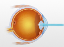 IOL - Blog - Correção Visual a Laser Personalizada para o seu Astigmatismo (thumb)
