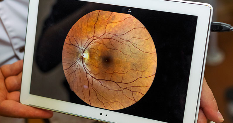 Hospital de Olhos Limongi - Blog - 3 sinais que indicam doenças na retina