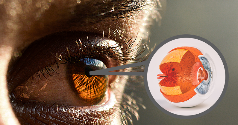 Hospital de Olhos - Blog - O que é o deslocamento de retina