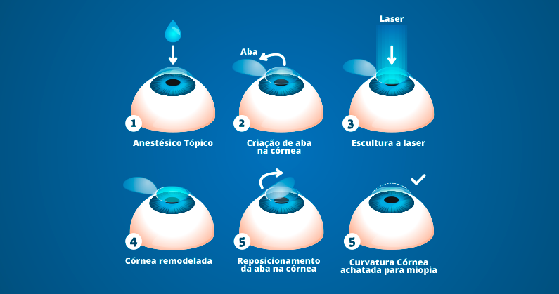 08 - Lasik ou PRK - Site
